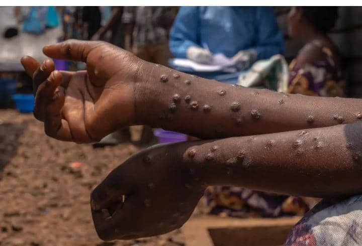La OMS sigue alertando al mundo por el brote de Mpox